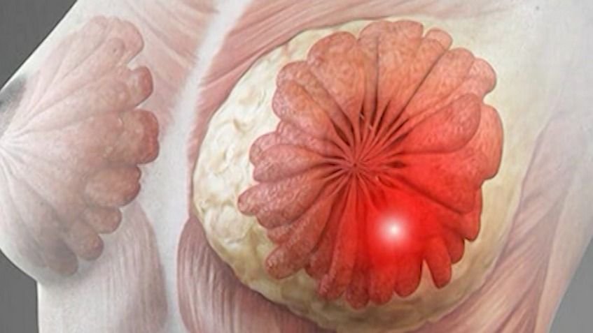 Breast cancer cases rise among younger women; experts call for early screening